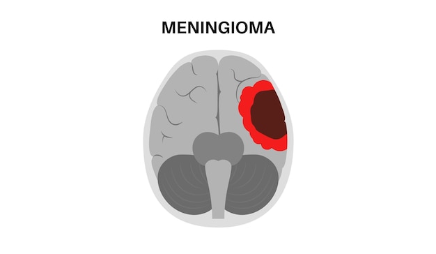 brain tumor symptoms