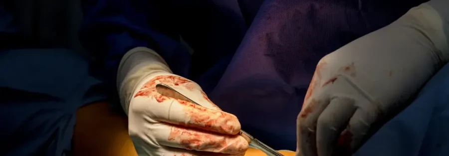 PLID surgery in Dhaka