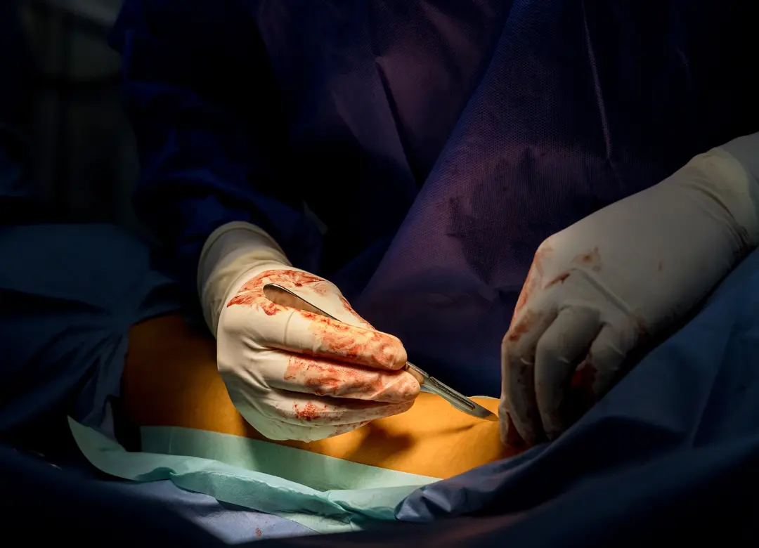 PLID surgery in Dhaka