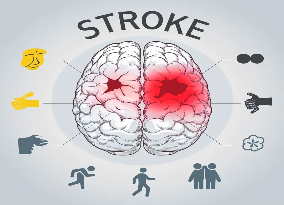 Stroke