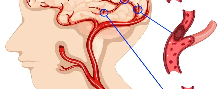 Nerve Disorders