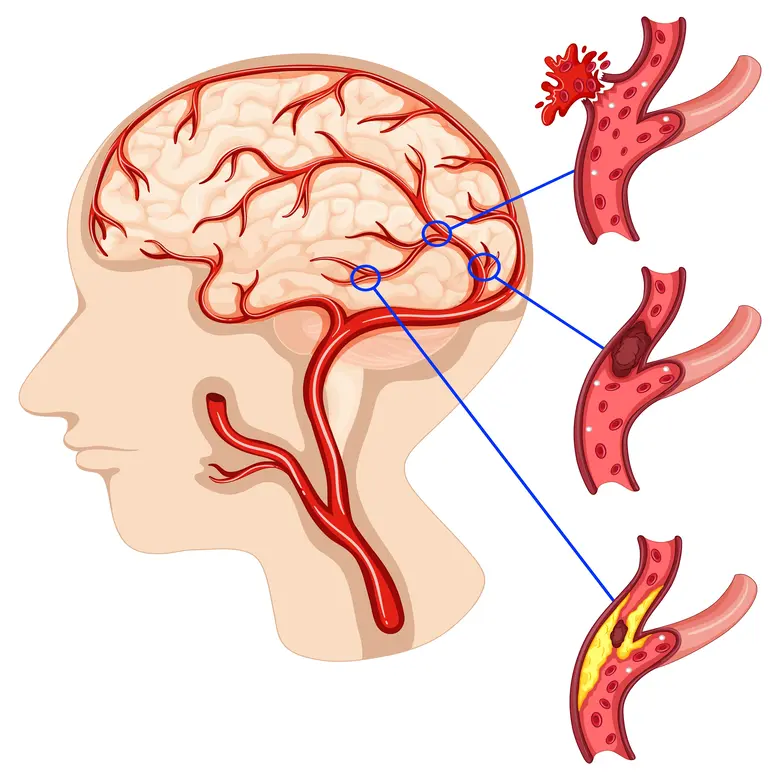 Nerve Disorders